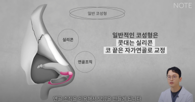 강남 코성형외과 코수술 잘하는 곳 추천 논현역 노트성형외과의 무보형물 자가연골 코성형수술로 자연스러운 코성형 관련 이미지 6