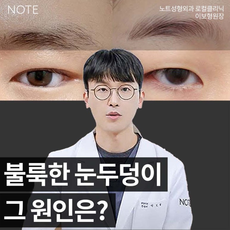 강남 눈성형외과 쌍꺼풀수술 잘하는 곳 논현역 노트성형외과의 불룩한 눈두덩이 원인과 적합한 케이스별 쌍수 방법은? 관련 이미지 1