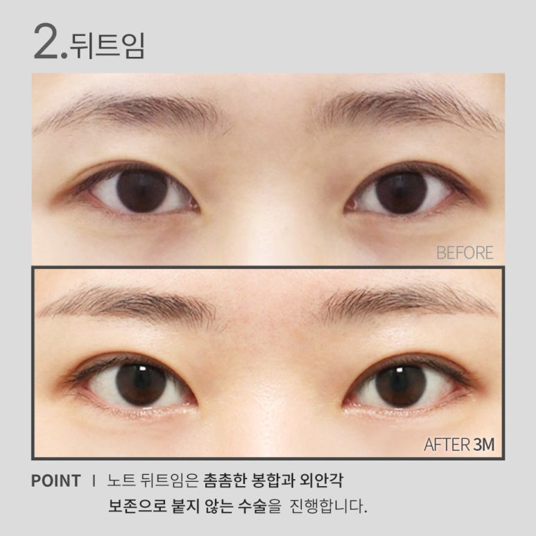 논현 눈성형 잘하는 곳 노트성형외과의 눈앞트임, 뒤트임, 밑트임, 듀얼트임까지! 트임성형 효과 확실한 눈트임수술 관련 이미지 5