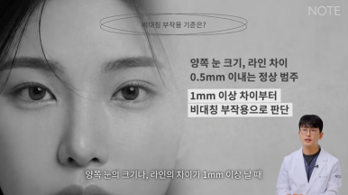 강남 눈재수술 성형외과 눈성형 잘하는 곳 논현 노트성형외과가 말하는 비대칭 쌍꺼풀 재수술 방법은? 관련 이미지 7