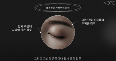 강남 눈성형외과 쌍꺼풀수술 잘하는 곳 논현역 노트성형외과의 불룩한 눈두덩이 원인과 적합한 케이스별 쌍수 방법은? 관련 이미지 11