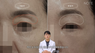 논현 리프팅 안면거상술 유명한 곳 추천 강남 노트성형외과의 안면거상 케이스 리뷰 수술 후 한 달 차 관련 이미지 8