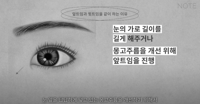 Double Eyelid Surgery: Is There a Procedure That Makes the Eyes Even Prettier When Done Together? A Great Place for Eye Plastic Surgery in Gangnam — NOTE Plastic Surgery: Canthoplasty, Ptosis Correction, and Forehead Lift image 15
