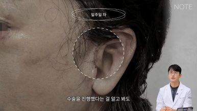 논현 리프팅 안면거상술 유명한 곳 추천 강남 노트성형외과의 안면거상 케이스 리뷰 수술 후 한 달 차 관련 이미지 12