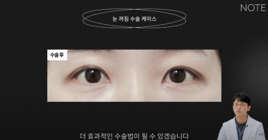 For a Seoul Eye Plastic Surgery Clinic in Gangnam, What Is the Right Procedure for Sunken Eyes? Note Plastic Surgery near Nonhyeon Station: Eyelid Correction Surgery and Fat Grafting for Sunken Eyes image 10
