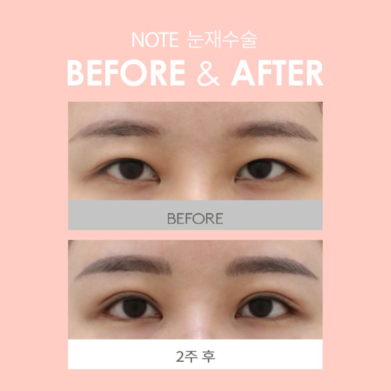 소세지 눈재수술, 눈재수술 붓기 걱정 없는 논현역 눈재수술 성형외과 노트의 당신에게만 집중하는 눈재수술 관련 이미지 7