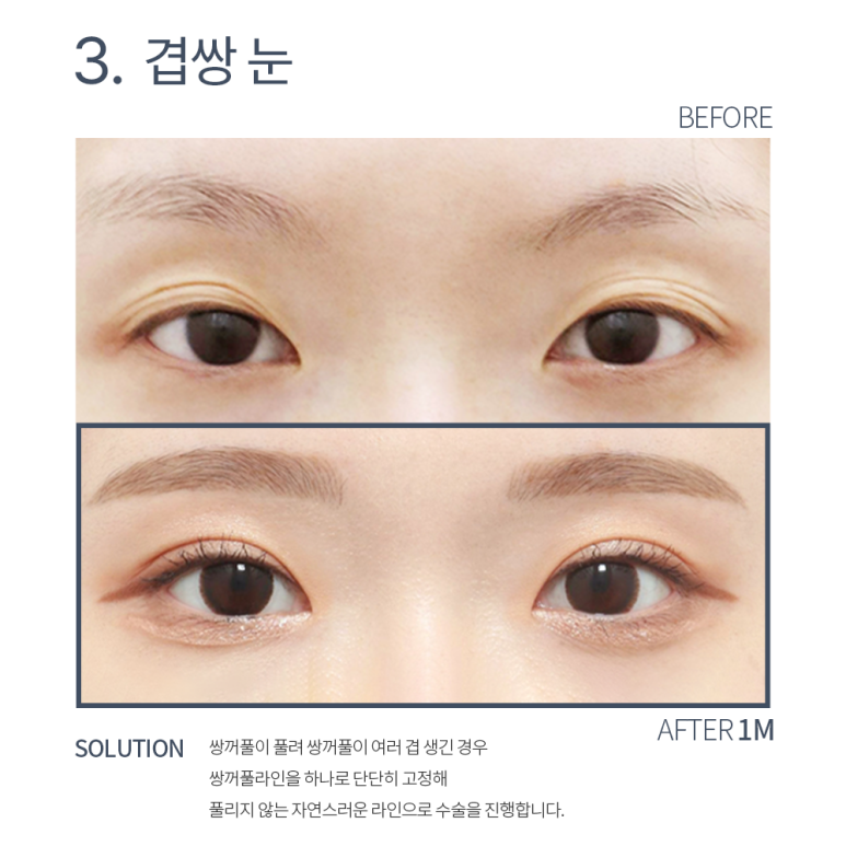자연유착 쌍꺼풀 후기가 궁금하다면? 강남 눈성형외과 쌍수 잘하는 곳 논현역 노트성형외과의 다중매몰 자연유착으로 자연스러운 쌍수 관련 이미지 7