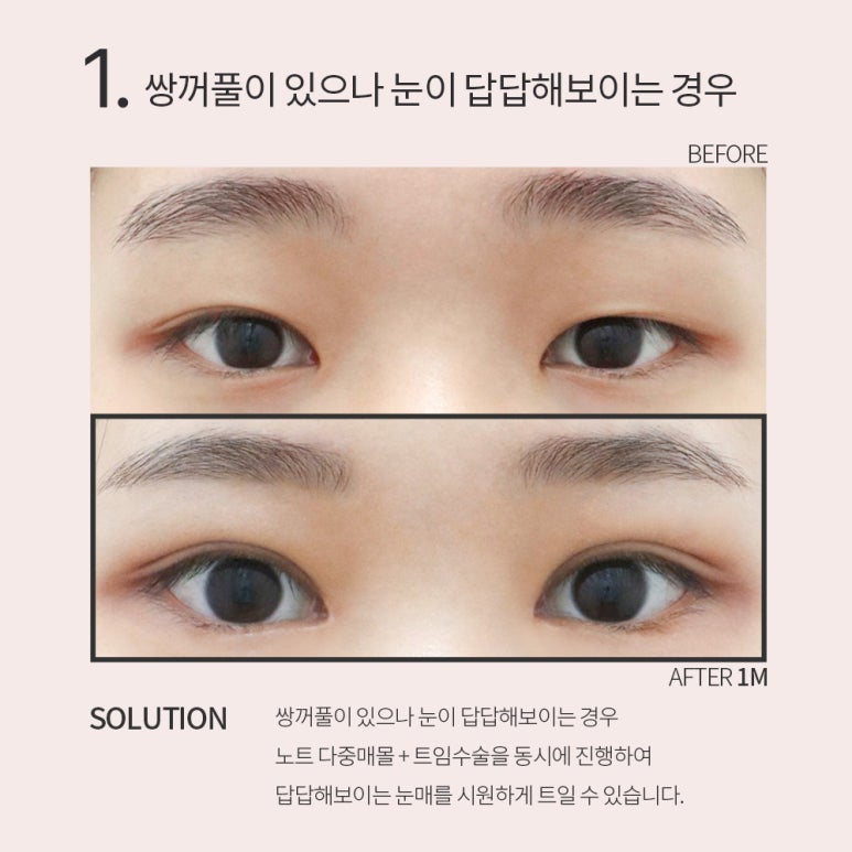 강남 눈성형외과 유명한 곳 추천 노트성형외과의 쌍꺼풀수술 전후는? 올인원 눈성형으로 매몰쌍수와 트임수술을 한번에! 관련 이미지 9