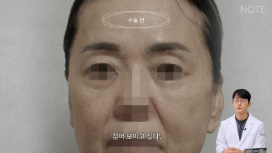 논현 안면거상 성형외과 리프팅 유명한 곳 강남 노트성형외과의 안면거상 케이스 리뷰 수술 전 고민 관련 이미지 3