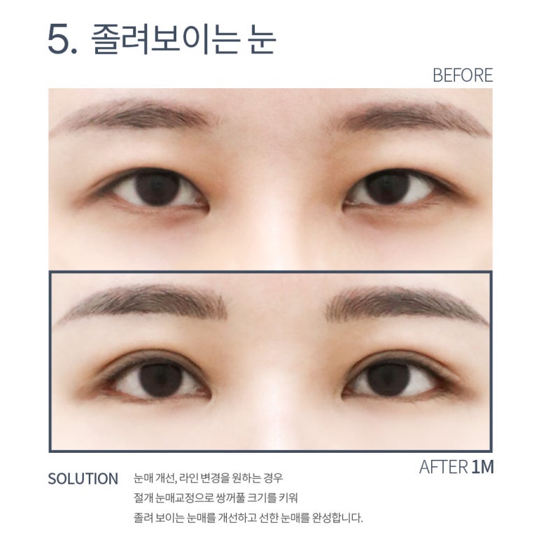 강남 쌍꺼풀재수술 잘하는 곳 논현역 노트성형외과의 소시지 쌍수 눈재수술 후기 관련 이미지 11