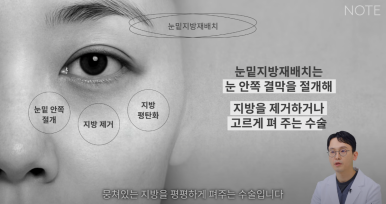 논현 눈성형외과 추천 하안검수술 눈밑지방재배치 잘하는 곳 강남 노트성형외과의 중년 눈성형 케이스 비교 분석 관련 이미지 9
