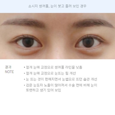 A Review of Revision Eyelid Surgery That Speaks for Itself: A Famous Eyelid Surgery Clinic Near Nonhyeon Station, Note Plastic Surgery’s Final Revision Eyelid Surgery Recommendations and Case Explanations image 7
