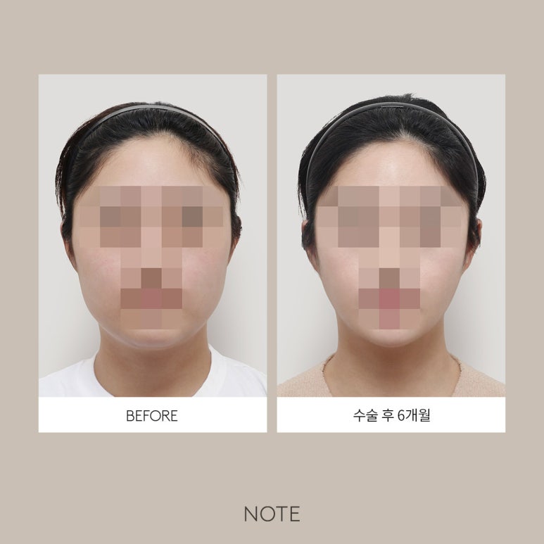 노트성형외과 _ 광대 축소의 모든것 관련 이미지 5