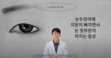 꺼진 눈이 생기는 이유는 따로 있다? 강남 눈성형 잘하는 곳 추천 노트성형외과의 눈꺼짐 해결을 위한 쌍커풀성형과 눈매교정, 지방이식수술 관련 이미지 5