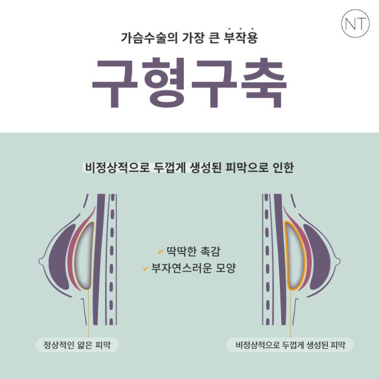 가슴 재수술, 정확한 원인 파악부터 하세요! 관련 이미지 2