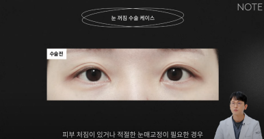 For a Seoul Eye Plastic Surgery Clinic in Gangnam, What Is the Right Procedure for Sunken Eyes? Note Plastic Surgery near Nonhyeon Station: Eyelid Correction Surgery and Fat Grafting for Sunken Eyes image 7