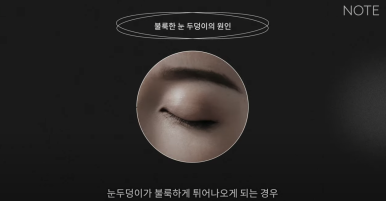 강남 눈성형외과 쌍꺼풀수술 잘하는 곳 논현역 노트성형외과의 불룩한 눈두덩이 원인과 적합한 케이스별 쌍수 방법은? 관련 이미지 8