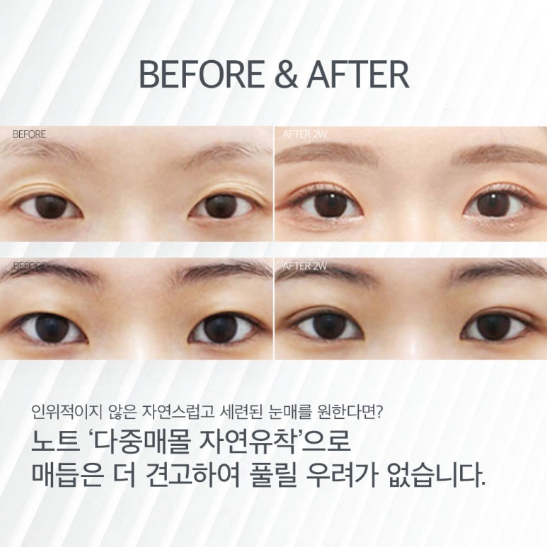 강남 눈성형 쌍수 잘하는 곳, 논현 쌍커풀 성형외과 노트의 오래가는 다중매몰 쌍꺼풀수술 전후로 확인하는 자연유착 쌍커풀 효과 관련 이미지 8