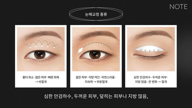 논현 쌍꺼풀수술 눈성형 유명한 곳 추천 강남 노트성형외과의 절개 눈매교정이란? 관련 이미지 8
