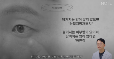 논현 눈수술 성형외과 유명한 곳 눈밑지방재배치 추천 강남 노트성형외과의 눈밑지하안검을 구분하는 자가진단법? 관련 이미지 6
