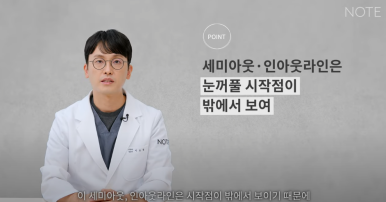논현역 눈성형 잘하는 곳 노트성형외과의 인라인, 인아웃라인, 아웃라인 쌍꺼풀라인별 쌍꺼풀수술 후 느낌 미리보기 관련 이미지 18