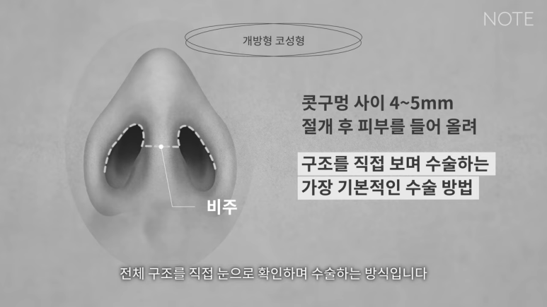 논현 코수술 코성형 유명한 곳 추천 강남 노트성형외과가 말하는 개방 코성형이란? 관련 이미지 3