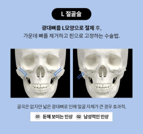 [노트성형외과] 노트 FULL 광대 축소 관련 이미지 2