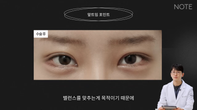 강남 트임수술 쌍꺼풀 눈성형 잘하는 곳 추천 논현 노트성형외과의 트임을 하는 이유, 앞트임이란? 관련 이미지 7