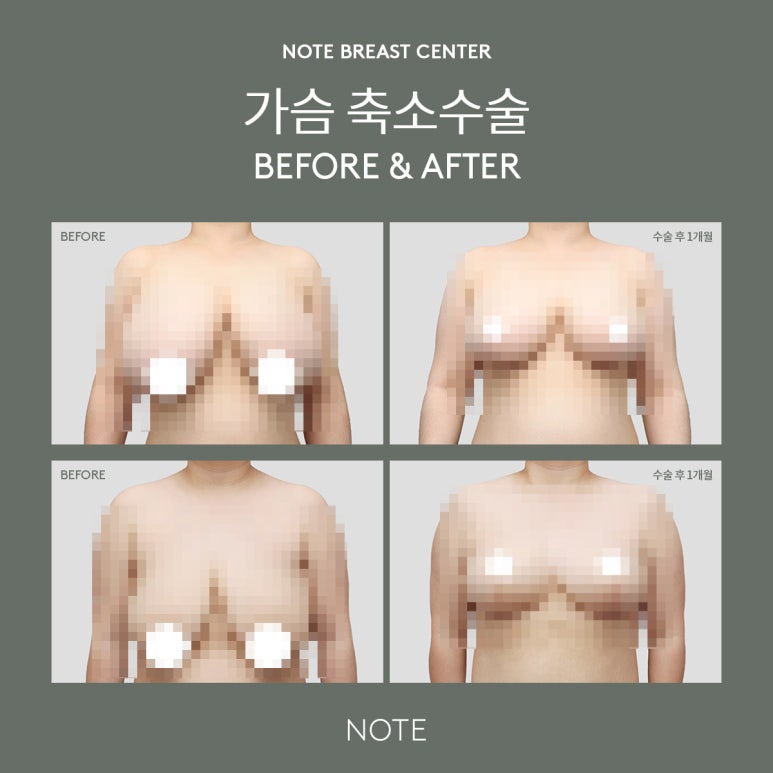 [Note Plastic Surgery] Let’s Learn About Breast Reduction! image 7