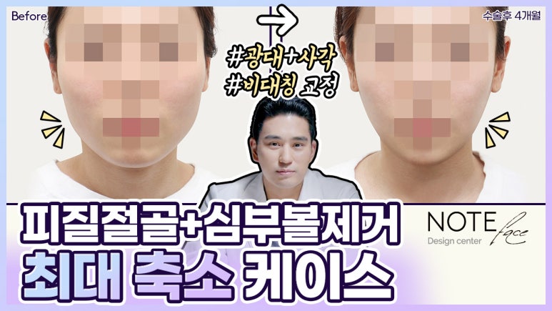 노트성형외과 _ 광대 축소의 모든것 관련 이미지 6