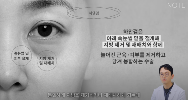 논현 눈성형외과 추천 하안검수술 눈밑지방재배치 잘하는 곳 강남 노트성형외과의 중년 눈성형 케이스 비교 분석 관련 이미지 11