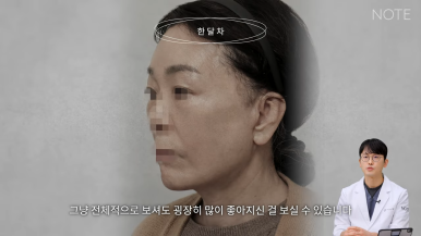 논현 리프팅 안면거상술 유명한 곳 추천 강남 노트성형외과의 안면거상 케이스 리뷰 수술 후 한 달 차 관련 이미지 6