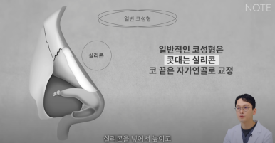 강남 코성형외과 코수술 잘하는 곳 추천 논현역 노트성형외과의 무보형물 자가연골 코성형수술로 자연스러운 코성형 관련 이미지 4