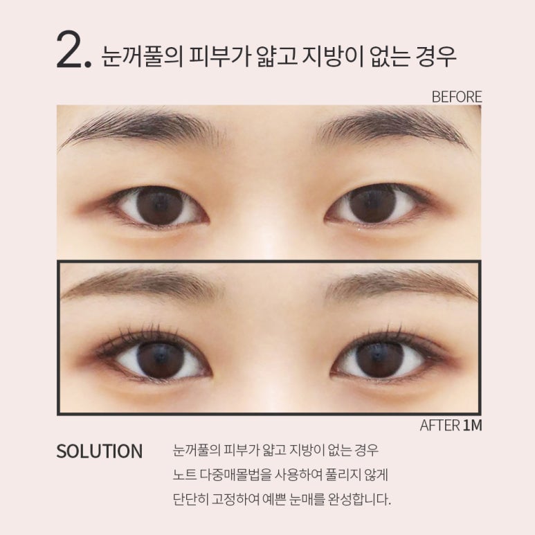 강남 눈성형외과 유명한 곳 추천 노트성형외과의 쌍꺼풀수술 전후는? 올인원 눈성형으로 매몰쌍수와 트임수술을 한번에! 관련 이미지 10