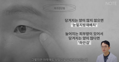 논현 눈수술 성형외과 유명한 곳 눈밑지방재배치 추천 강남 노트성형외과의 눈밑지하안검을 구분하는 자가진단법? 관련 이미지 10