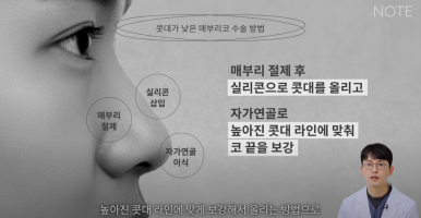 Gangnam Male Nose Surgery, Hump Nose Rhinoplasty, a Place Known for Good Natural Nose Surgery Recommendation: What Is the Hump Nose Surgery Method at Note Plastic Surgery in Nonhyeon? image 17