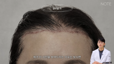 논현 리프팅 안면거상술 유명한 곳 추천 강남 노트성형외과의 안면거상 케이스 리뷰 수술 후 한 달 차 관련 이미지 3
