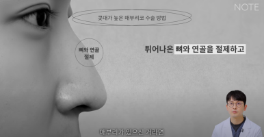 Gangnam Male Nose Surgery, Hump Nose Rhinoplasty, a Place Known for Good Natural Nose Surgery Recommendation: What Is the Hump Nose Surgery Method at Note Plastic Surgery in Nonhyeon? image 9