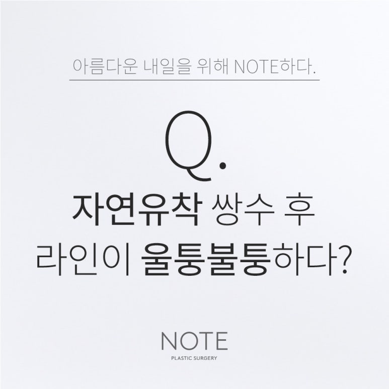 강남 쌍수 자연유착 눈성형 잘하는 곳 논현 노트성형외과의 자연유착 쌍수 후 울퉁불퉁한 라인 걱정이라면? 관련 이미지 1