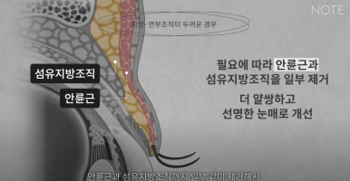 강남 눈성형외과 추천 눈수술 잘하는 곳 논현역 노트성형외과의 두꺼운 눈두덩이 눈위지방이 많다면? 관련 이미지 22