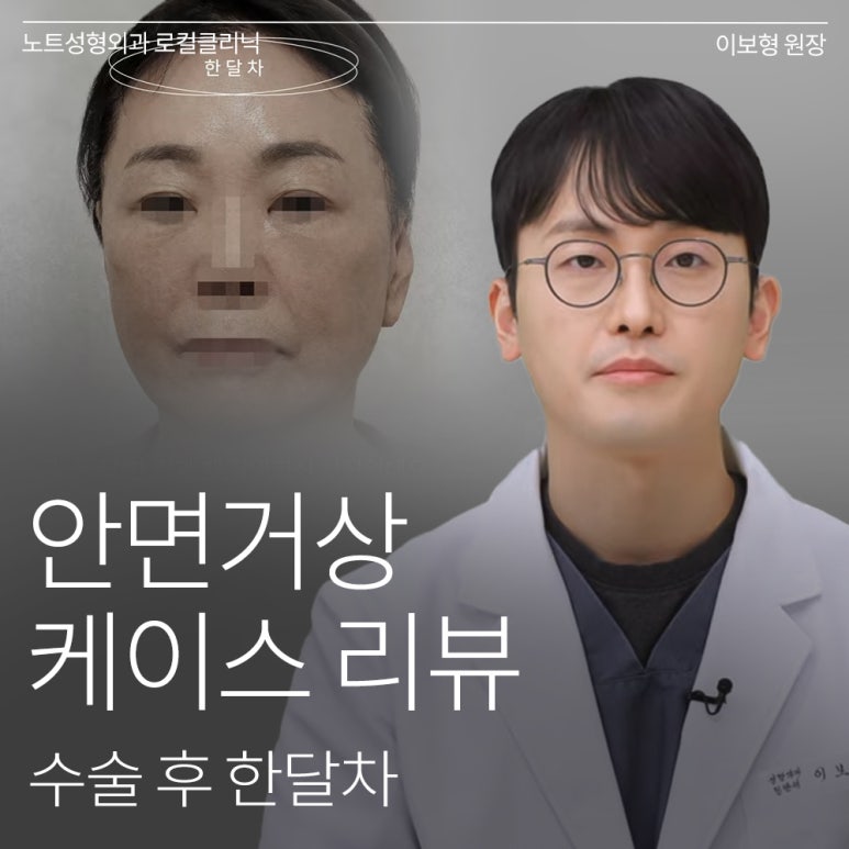 논현 리프팅 안면거상술 유명한 곳 추천 강남 노트성형외과의 안면거상 케이스 리뷰 수술 후 한 달 차 관련 이미지 1