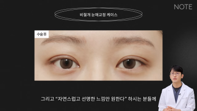 Recommended Famous Place for Double Eyelid Surgery and Eye Plastic Surgery in Nonhyeon: What Is Non-Incisional Ptosis Correction at Note Plastic Surgery in Gangnam? image 5
