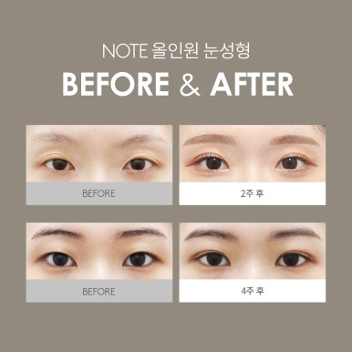 쌍꺼풀 매몰과 트임을 동시에 진행하는 노트만의 올인원 눈성형, 확실한 눈성형 효과를 원한다면? 논현 쌍꺼풀 수술 잘하는 곳, 노트성형외과의 올인원 눈성형 전후 후기 사진 확인하기! 관련 이미지 6