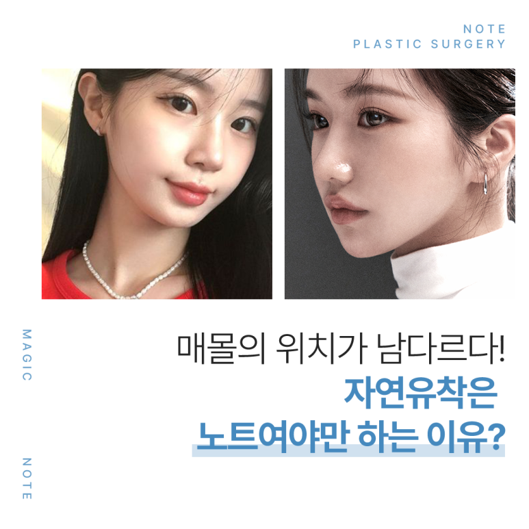 강남 눈성형 잘하는 병원, 자연유착 효과는? 노트성형외과의 오래가는 이중매몰 쌍꺼풀수술 관련 이미지 4