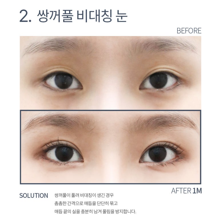 강남 쌍꺼풀재수술 잘하는 곳 논현역 노트성형외과의 소시지 쌍수 눈재수술 후기 관련 이미지 8