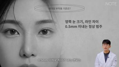 강남 눈재수술 성형외과 눈성형 잘하는 곳 논현 노트성형외과가 말하는 비대칭 쌍꺼풀 재수술 방법은? 관련 이미지 5