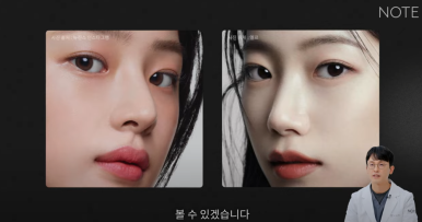 논현역 눈성형 잘하는 곳 노트성형외과의 인라인, 인아웃라인, 아웃라인 쌍꺼풀라인별 쌍꺼풀수술 후 느낌 미리보기 관련 이미지 7