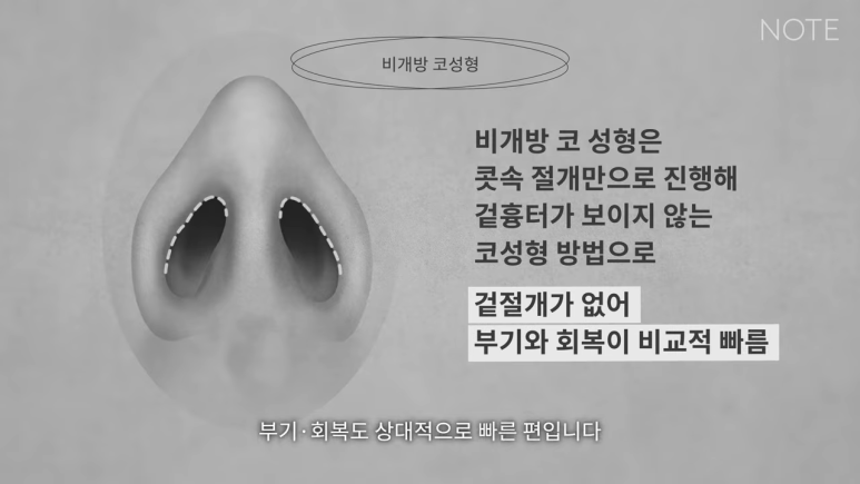 Recommended Gangnam Rhinoplasty Clinic: What Is Non-Open Rhinoplasty, as Explained by Note Plastic Surgery in Nonhyeon, a Place Known for Good Nose Surgery? image 3