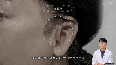 논현 리프팅 안면거상술 유명한 곳 추천 강남 노트성형외과의 안면거상 케이스 리뷰 수술 후 한 달 차 관련 이미지 13