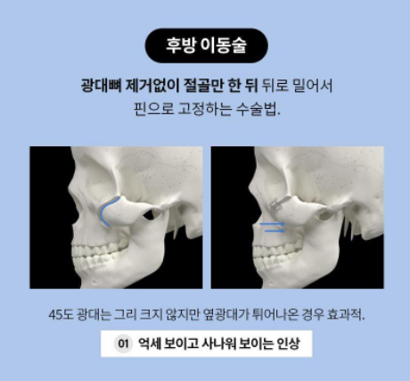 [노트성형외과] 노트 FULL 광대 축소 관련 이미지 4